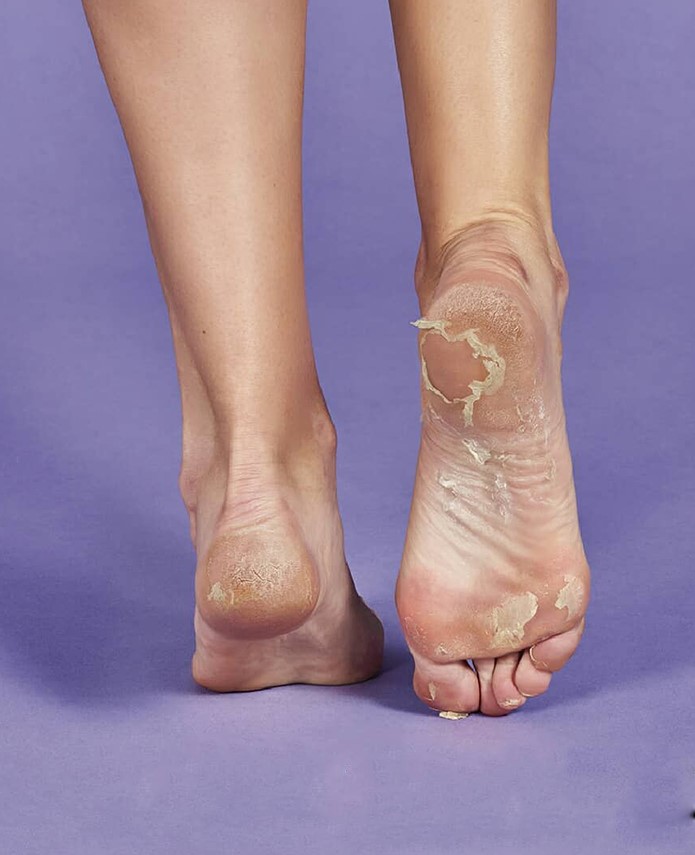 IROHA Glykolsäure Peeling & Exfoliation Socken - Image 5